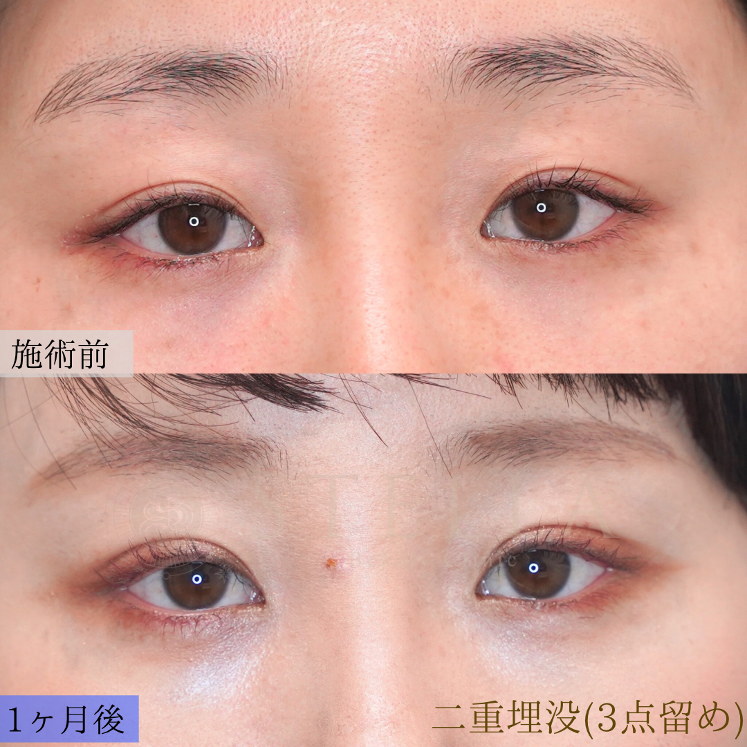 埋没二重術 症例写真