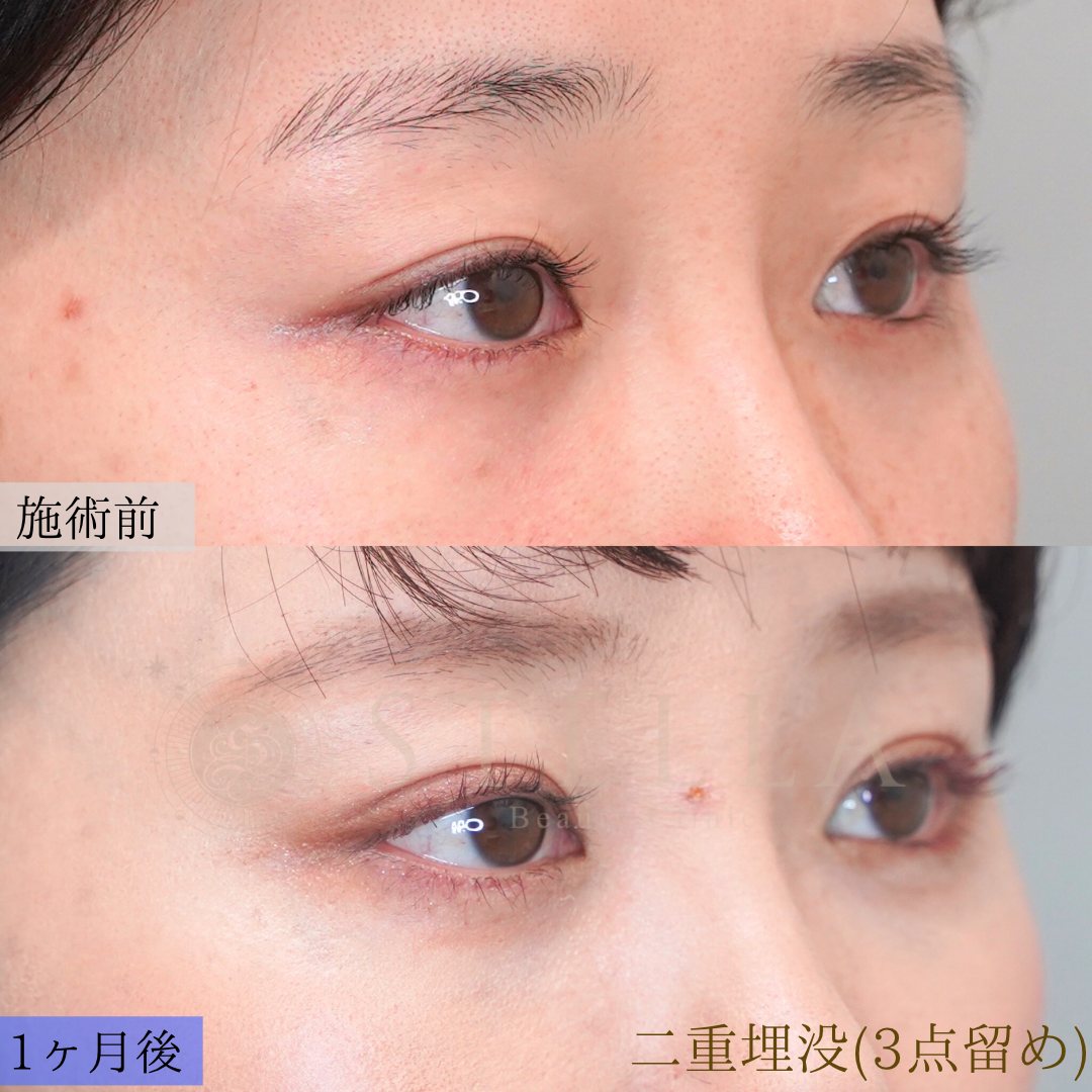 埋没二重術 症例写真