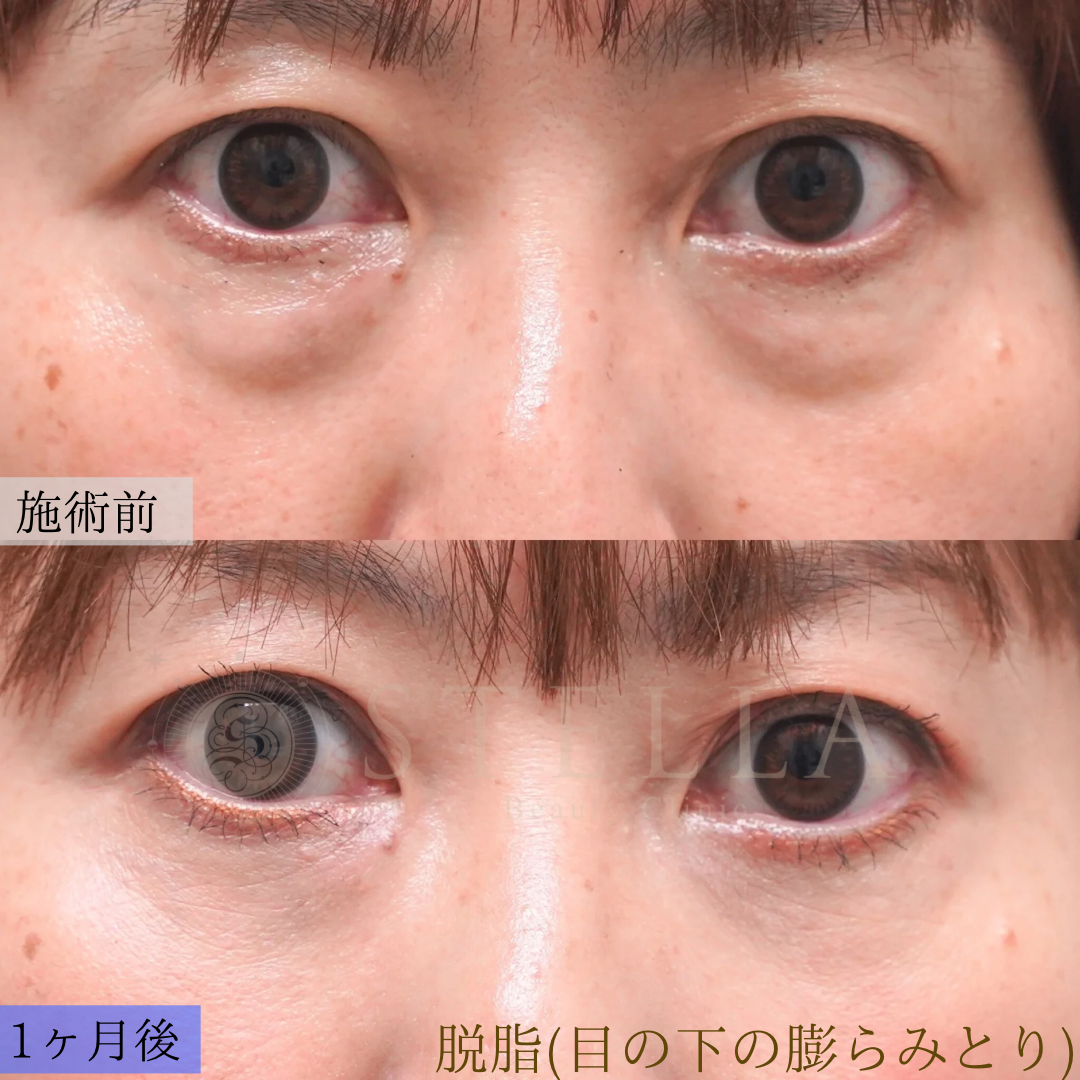 目の下のふくらみ取り 症例写真