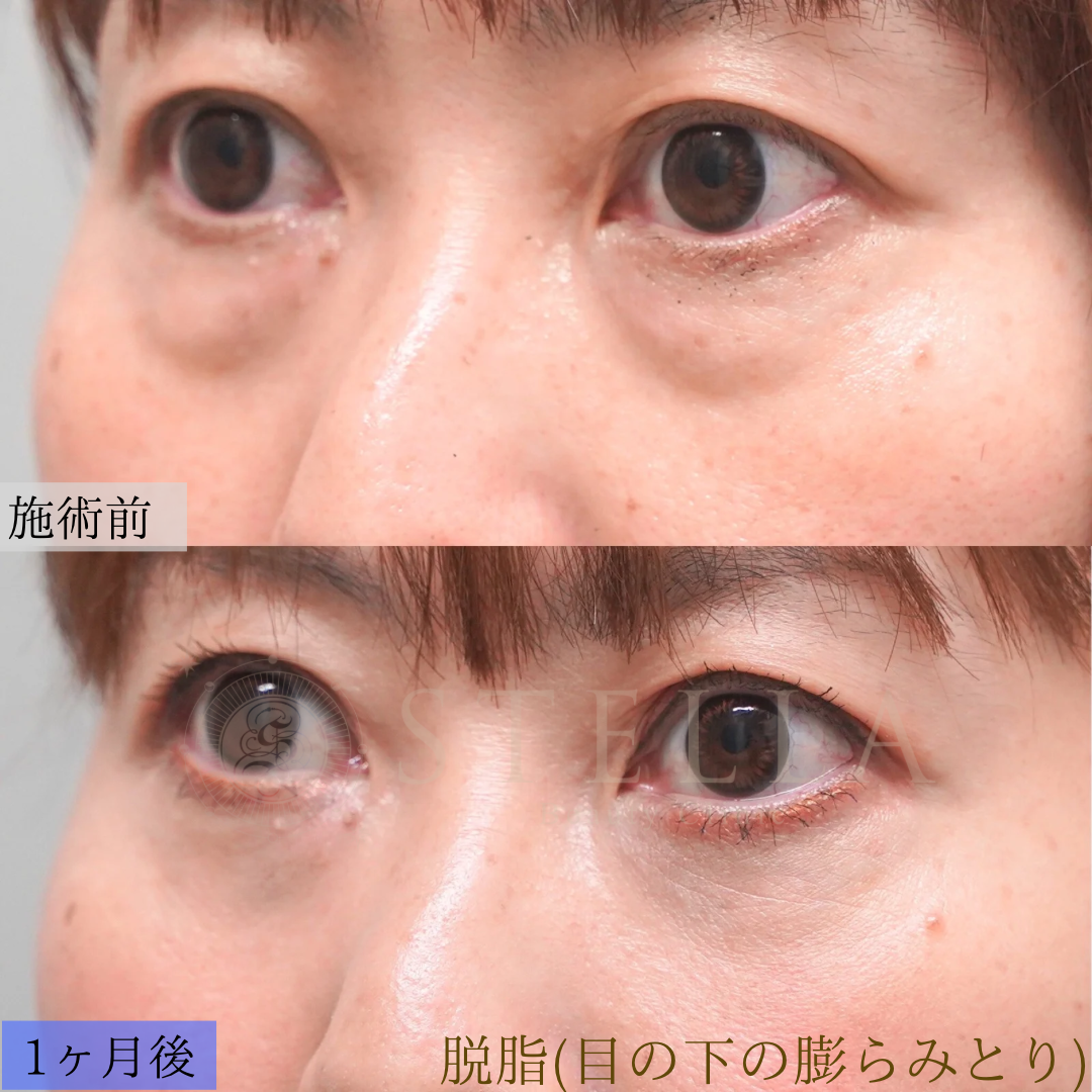 目の下のふくらみ取り 症例写真