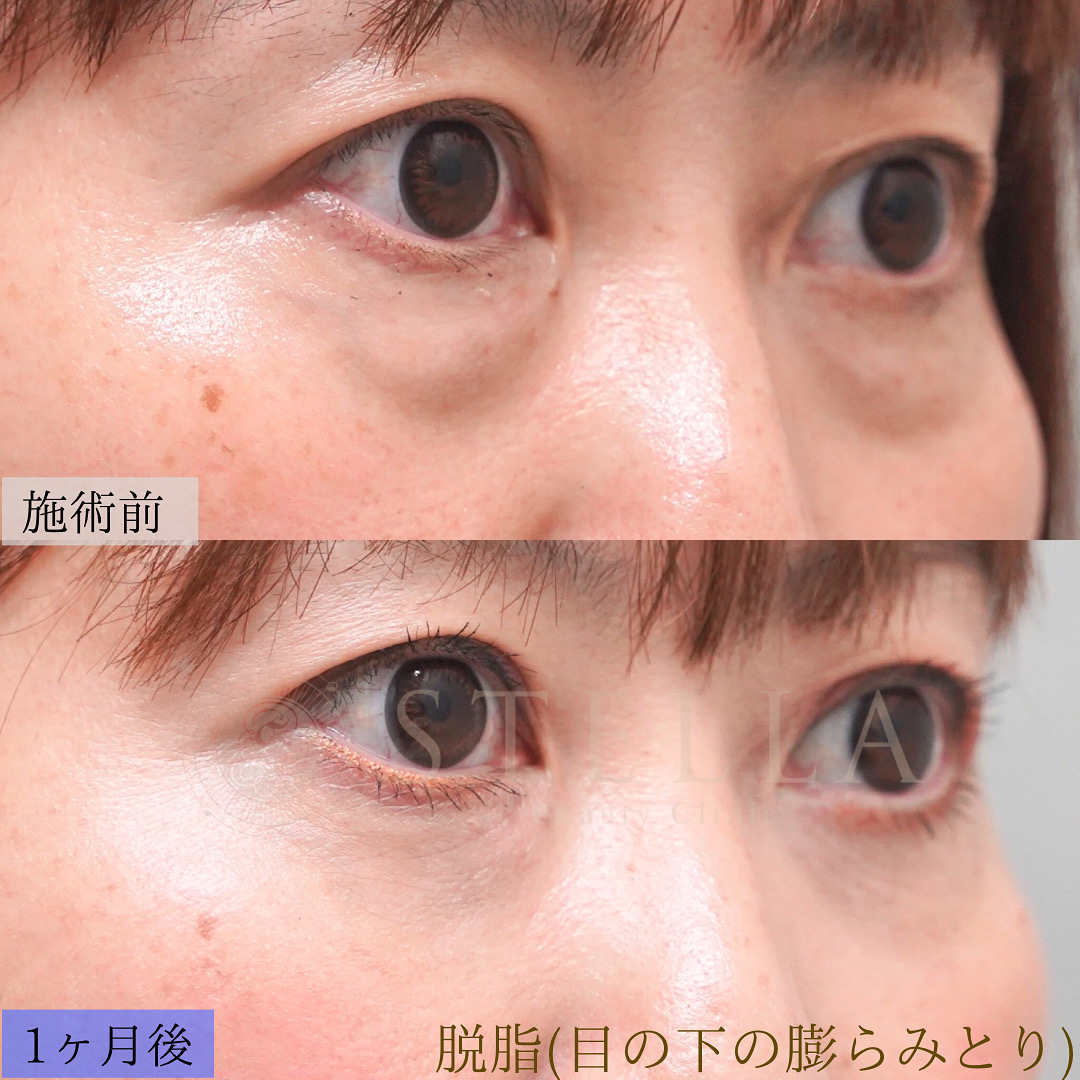 目の下のふくらみ取り 症例写真
