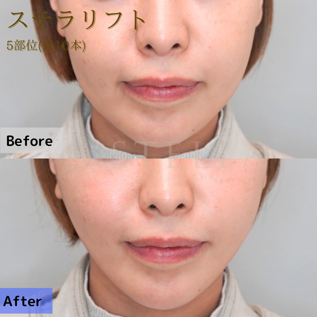 ステラリフト 症例写真